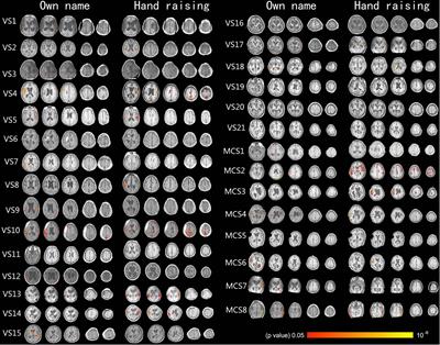 Detecting Brain Activity Following a Verbal Command in Patients With Disorders of Consciousness